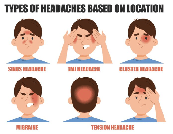 Types of Headaches Based on Location